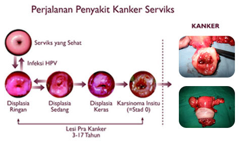 gejala-kankerserviks