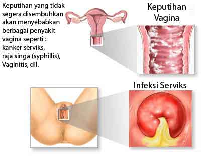 cara alami mengatasi keputihan