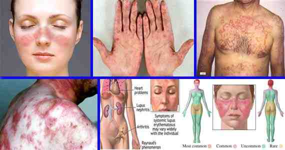 gejala seseorang terkena hiv aids