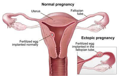 memahami gejala kehamilan diluar rahim
