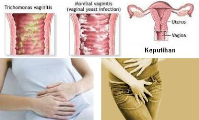 Ciri Ciri Keputihan Tidak Normal Penyebab dan Pengobatannya Ciri Ciri Keputihan Tidak Normal Penyebab dan Pengobatannya